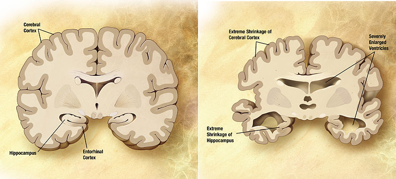 Datei:Alzheimer's disease brain comparison.jpg
