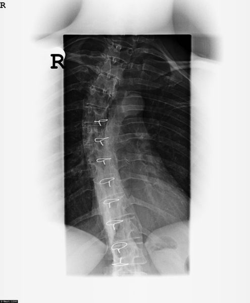 Datei:Röntgen Aufnahme Wirbelsäule Bandscheiben.jpg